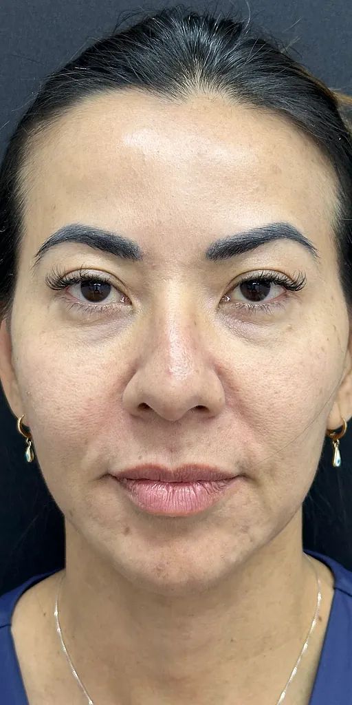 Antes - Resultado 1