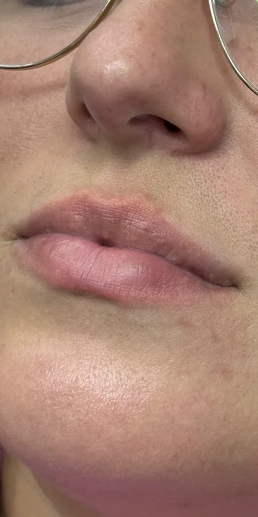 Antes - Resultado 3