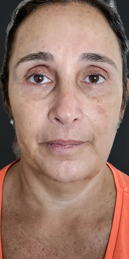 Antes - Resultado 4