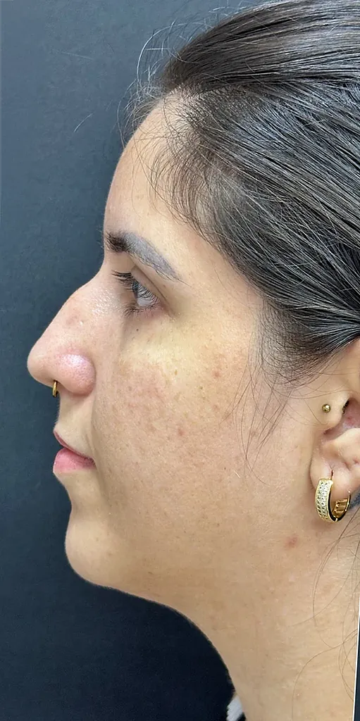 Antes - Resultado 5
