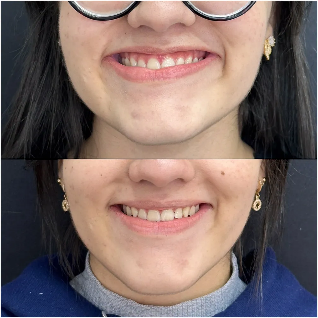 SORRISO GENGIVAL