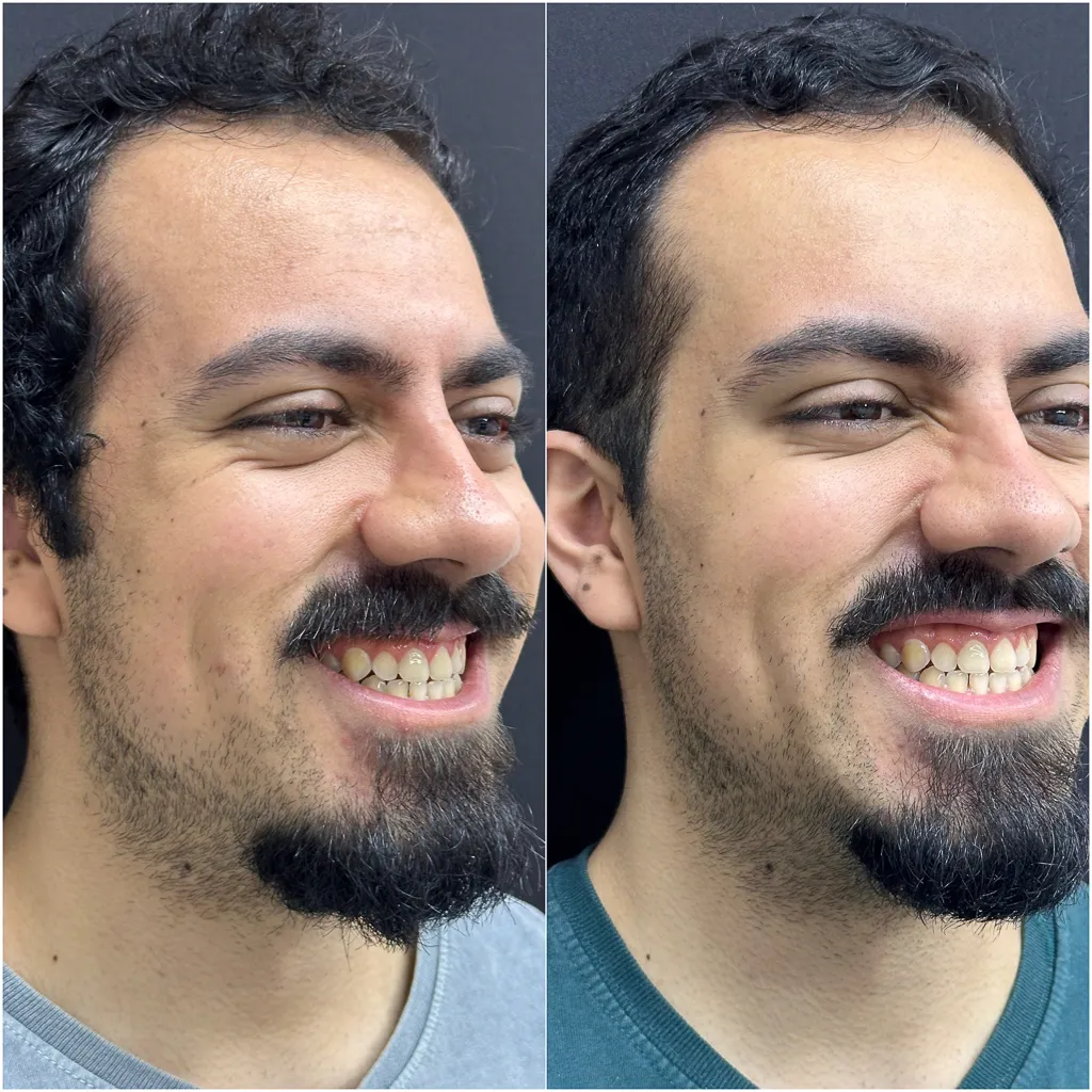 TERÇO SUPERIOR