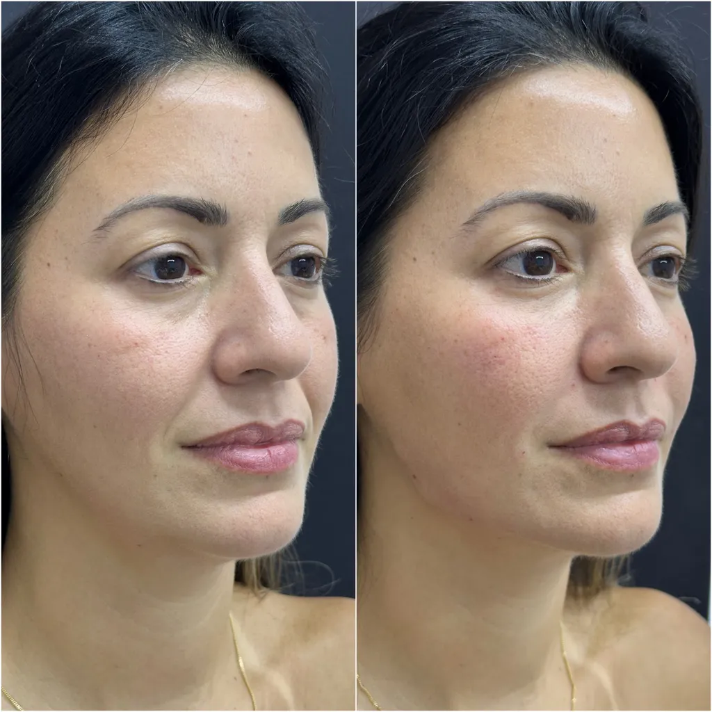 BIGODE CHINÊS (Sulco Nasolabial)