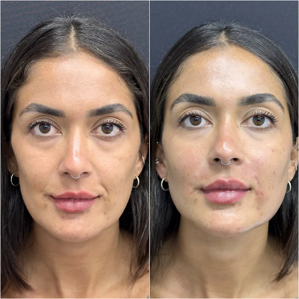 BIGODE CHINÊS (Sulco Nasolabial)