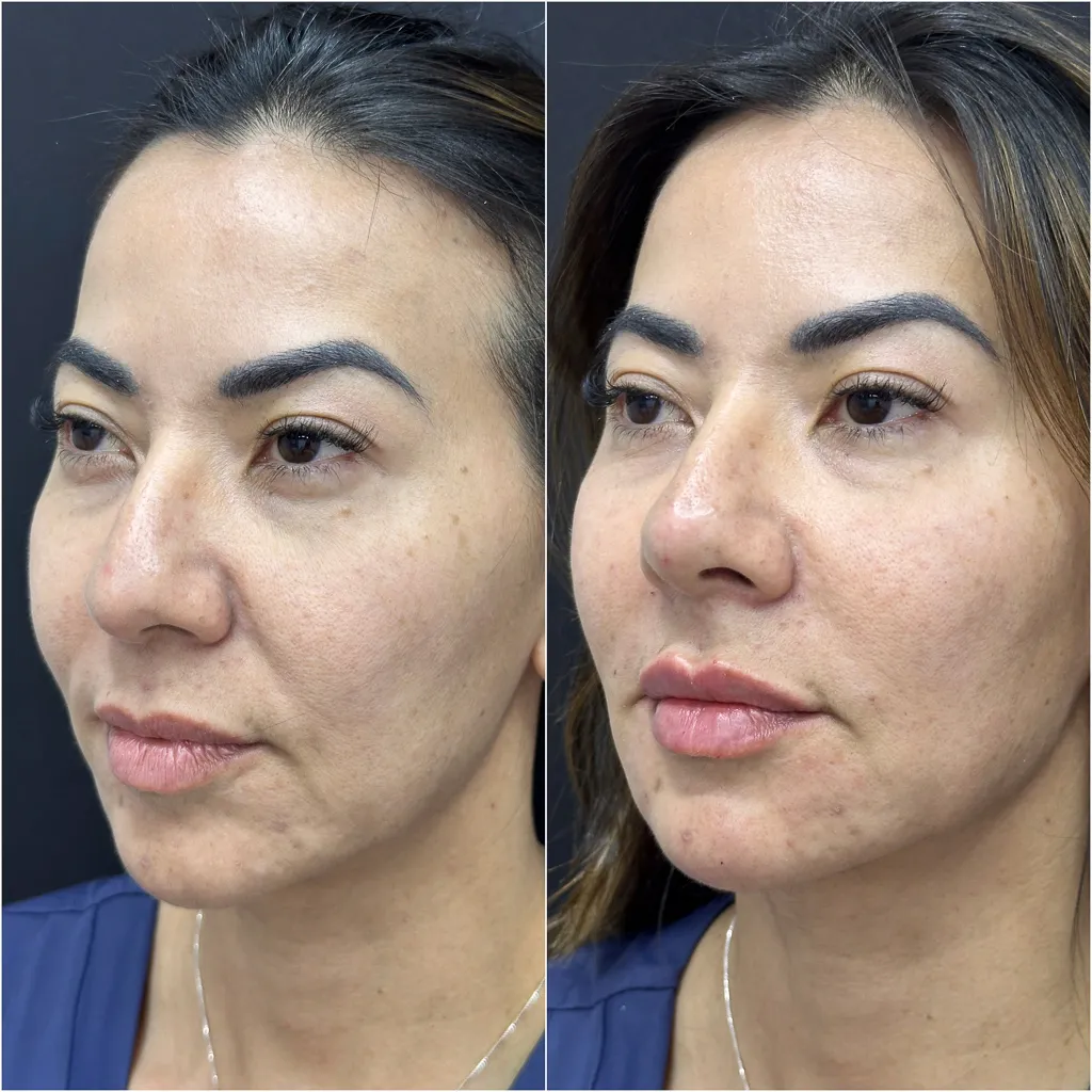 BIGODE CHINÊS (Sulco Nasolabial)