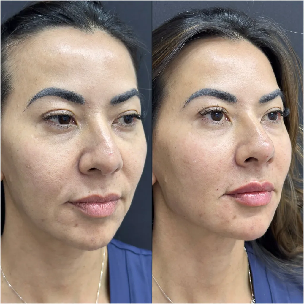 BIGODE CHINÊS (Sulco Nasolabial)