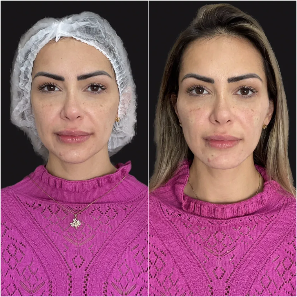 MALAR (Maçãs do rosto)