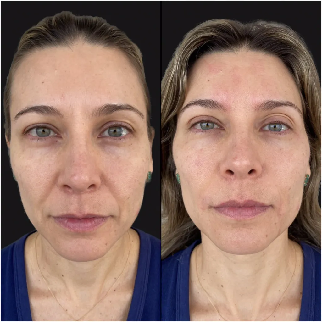 MALAR (Maçãs do rosto)