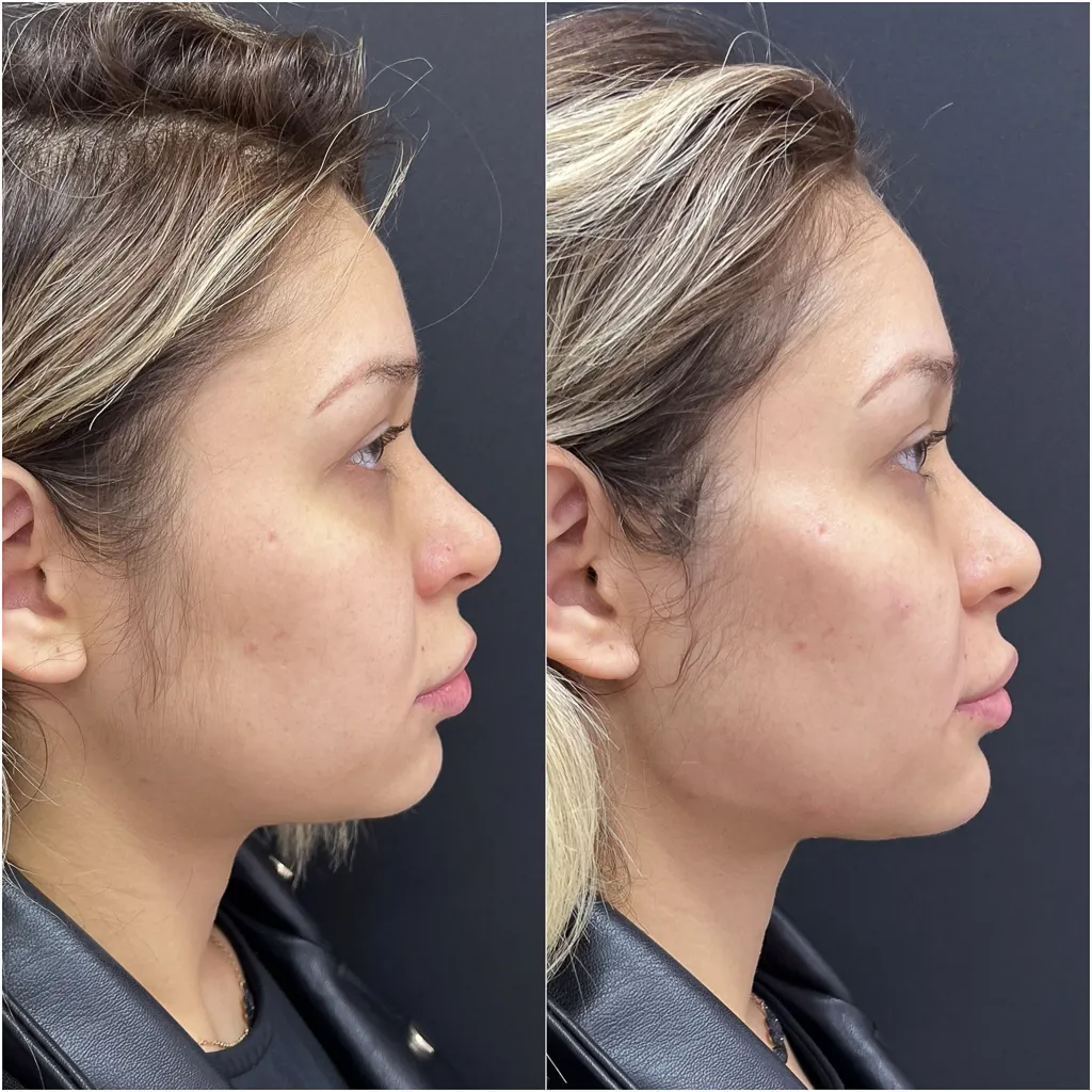 MALAR (Maçãs do rosto)